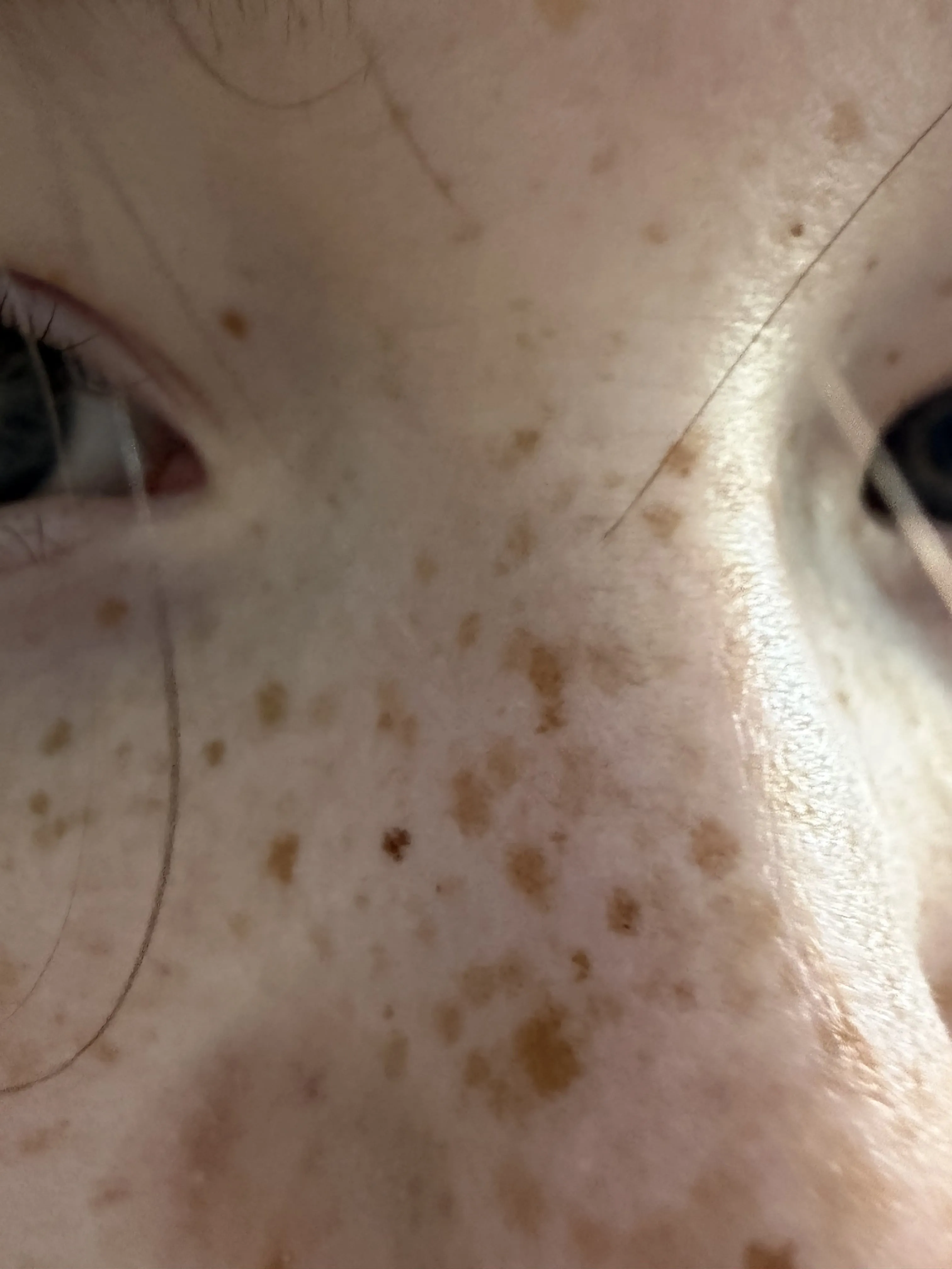Freckles